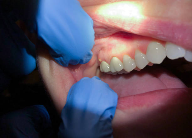 Best Emergency Dentist for Lost Fillings or Crowns in Bridgeville, PA